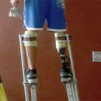 One brother has a prosthesis for his right leg -- ran into an issue in Iraq -- but can still use the stilts!